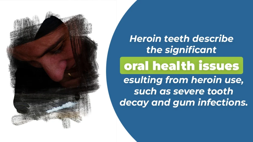 Heroin teeth describe the significant oral health issues resulting from heroin use, such as severe tooth decay and gum infections.