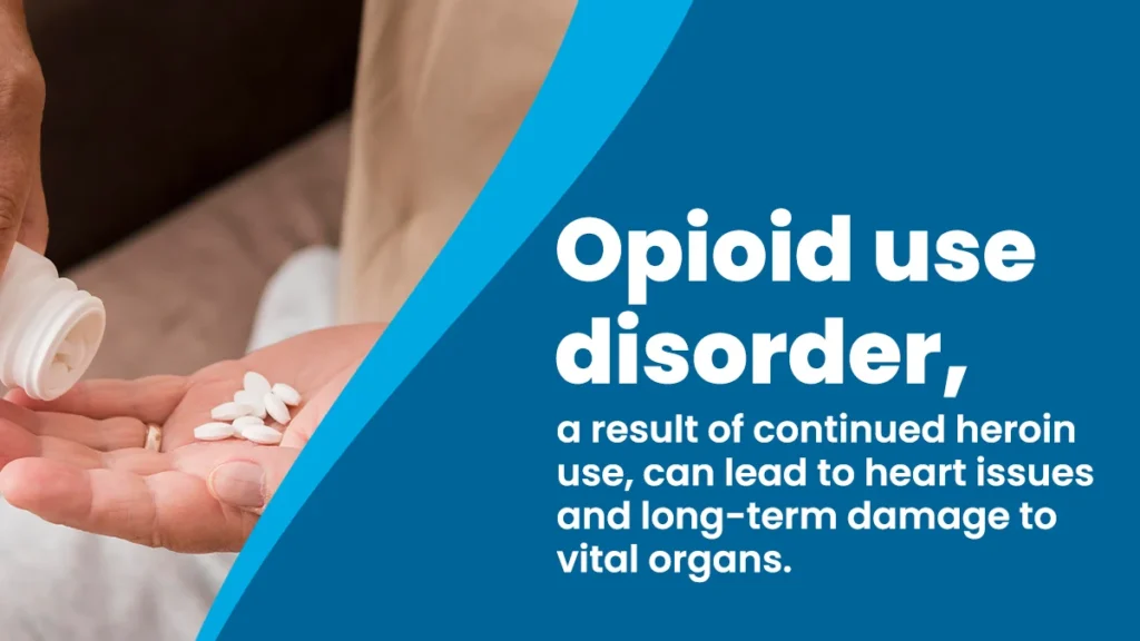 Opioid use disorder, a result of continued heroin use, can lead to heart issues and long-term damage to vital organs.